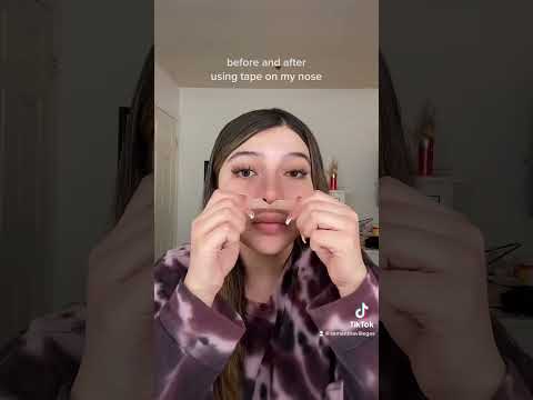 here’s a before and after using the tape on my nose #rhinoplasty #nosejob