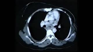 c Radiogra diag Intrathx Lymphadenopathy