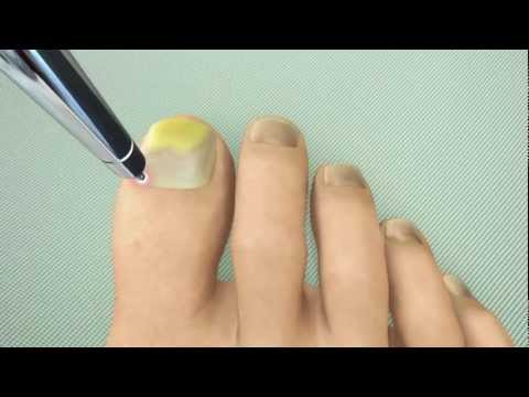Palatandaan ng halamang-singaw sa toenails Halamang-singaw sa kuko mga larawan