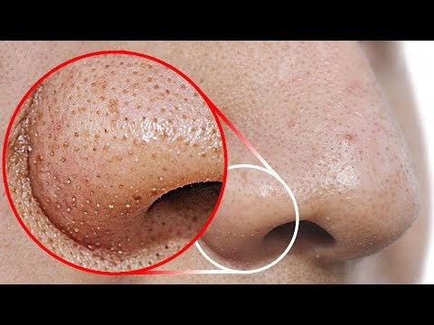 Do THIS to Remove Blackheads From Your Nose