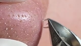 Download Lagu relax,Satisfying,nose blackheads,tweezers,acne treatment,鼻角栓,ピンセット,피지제거 031 Thumbnail