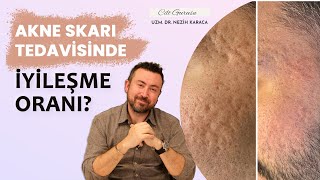 Akne Skarlarında Düzelme Oranı Ne Olmalı?