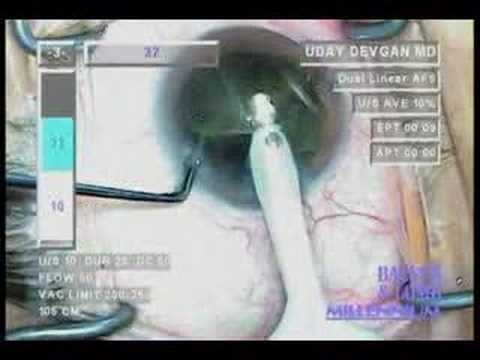 Cataract Surgery - Phacoemulsification