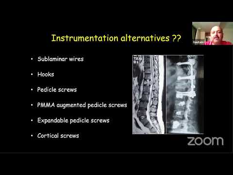 BSS Webinar - Osteoporosis - Whats The Final Verdict ?? Medical and Surgical