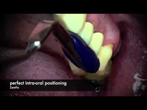 ZemFix® - The innovative cementing - Crown [Full HD]