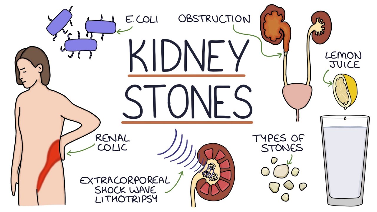 Understanding Kidney Stones