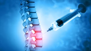 Epidural steroid injections