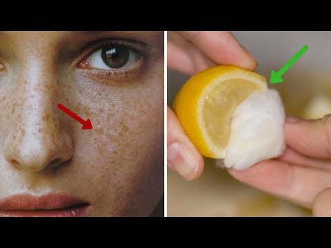 Want to Remove Freckles? | Best Home Remedies to Get...