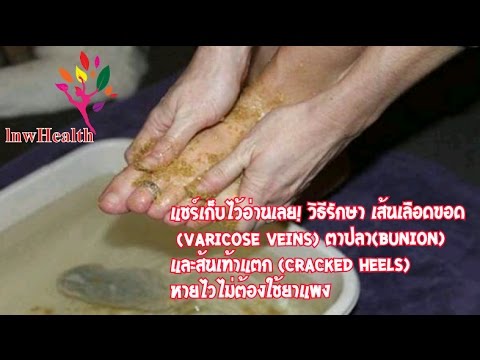 การรักษาด้วยการ PUVA ในเล็บโรคสะเก็ดเงิน งาดำรักษาโรคสะเก็ดเงิน