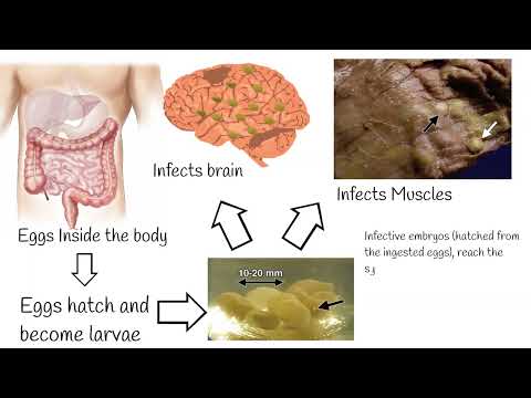 , title : 'Neurocisticcircosis  symptoms and treatment.   Why is pork tapeworm so dangerous?'