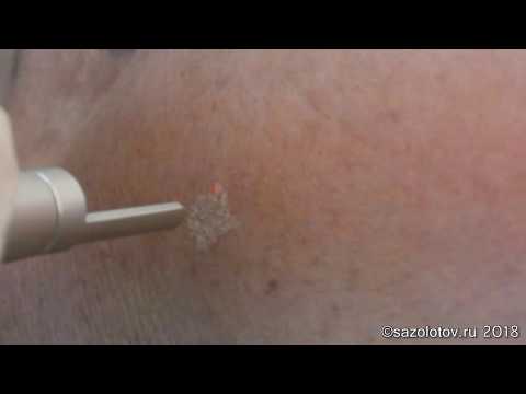 Пигментация кожи затылка Средства о пигментных пятен аптечные