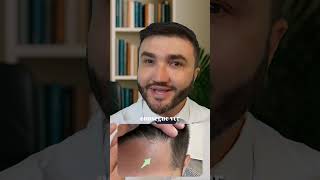 NÃO FAÇA SEU TRANSPLANTE CAPILAR ANTES DE ASSISTIR A ESSE VÍDEO