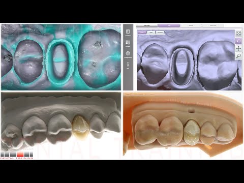 IOS 2012 cara Trios 1.0 vs Poly Vinyl Siloxane #sldentaltraining