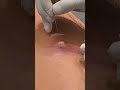 PUS-FILLED ABSCESS!