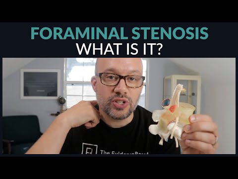 What is Foraminal Stenosis & How to Find Relief
