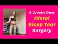 6 weeks post surgical distal bicep tear repair