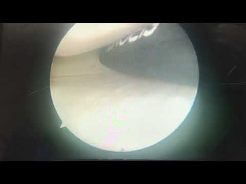 Amazing Video!!! How do they do this?! Meniscus repair surgery - what an awesome fix of my meniscus