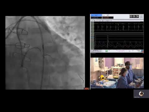 Retrograde PCI for native Circumflex artery CTO via occluded SVG
