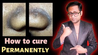 Black spot around nose and lips | Seborrheic melanosis treatment | Hindi