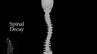 Spinal Decay - Scoliosis - Skull and Spine