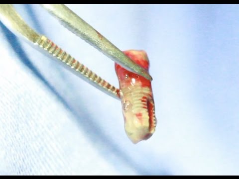 Retirada de implante dentário da cavidade do seio maxilar