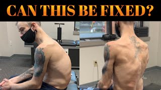 SEVERE Scoliosis + Kyphosis &amp; Chiropractic. Former Power Lifter Suffers Career Ending Injury.