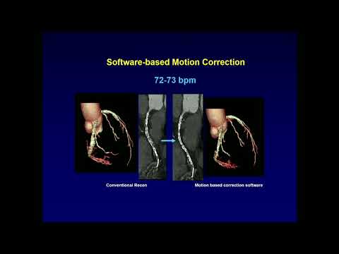 Sponsored Symposium | Changing the Beat in Cardiac Care with Advanced CT Technologies