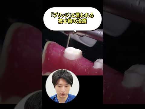 最新技術を使ったブリッジ治療#shorts