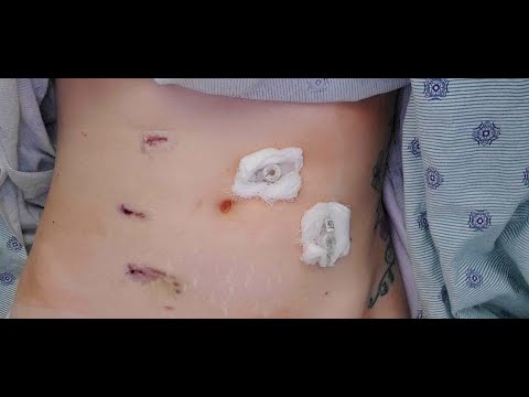 😨J Tube Exploratory Scope Surgery😨