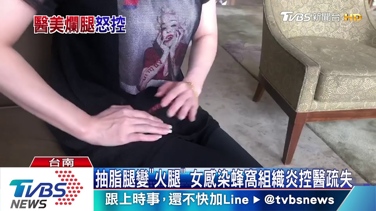 抽脂腿變「火腿」 女感染蜂窩組織炎控醫疏失