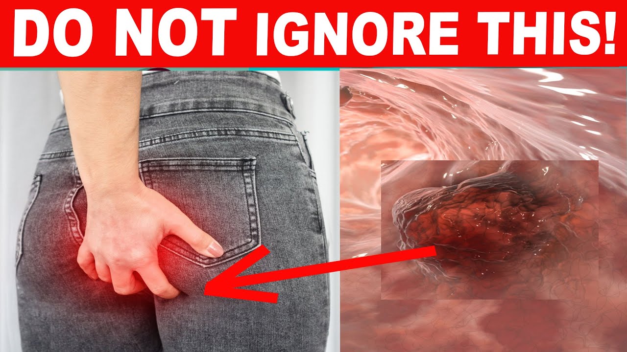 Early Warning Signs Of Colon Cancer You Should Not Ignore