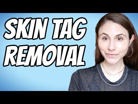 Skin tag removal #shorts