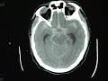 Endovascular Coiling - Ruptured Anterior Communicating Arterial Aneurysm