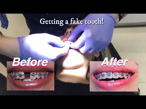 Braces With Fake Teeth Attached - How To Discuss