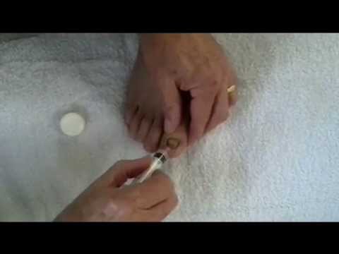 Ano ang mga pagkain ay maaaring kinakain sa fungus paa at mga kuko Lotseril pamahid review