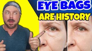The Truth About Under Eye Bags And Dark Circles And How To ERADICATE Them