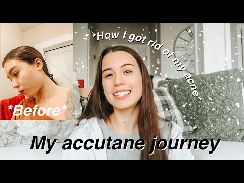 *six month* ACCUTANE JOURNEY | how i cleared my acne!! side effects, pros&cons, lots of pictures!!