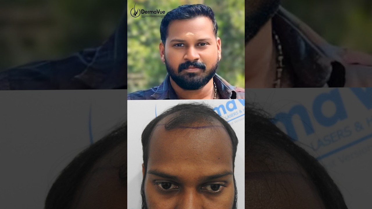 Full Hair Restoration — Before & After Journey