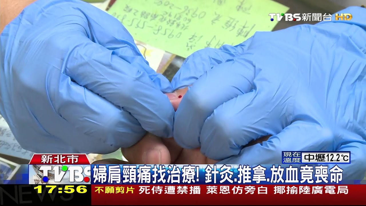 婦肩頸痛找治療! 針灸、推拿、放血竟喪命