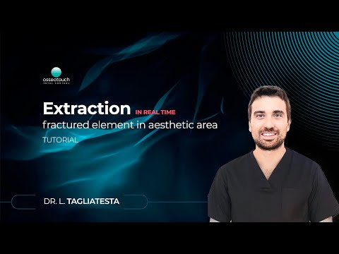 Kit Essential clinical case — real-time atraumatic extraction