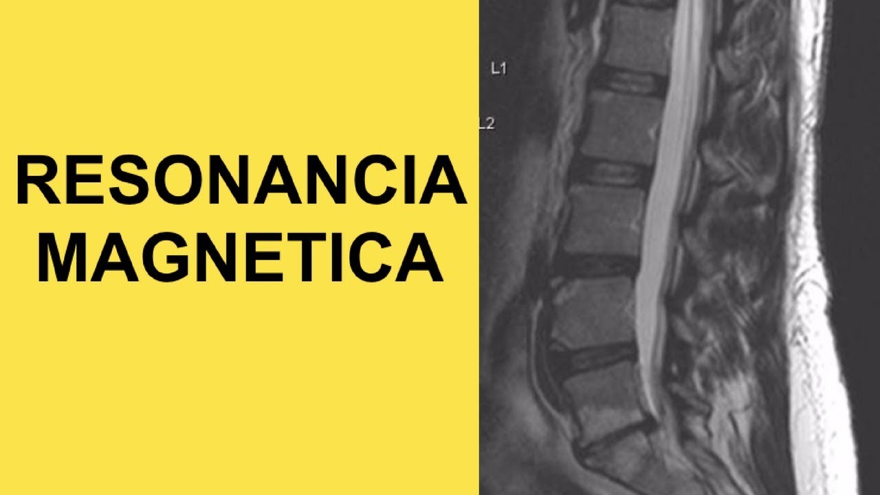 Watch Resonancia Magnetica Lumbar Para Diagnosis de Hernia de Disco (Causa de Ciatica) Now Resonancia Magnetica Lumbar Para Diagnosis de Hernia de Disco (Causa de Ciatica)