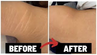 HOW I GOT RID OF MY STRETCH MARKS