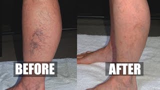 3 Natural Vein Solutions For Spider Veins