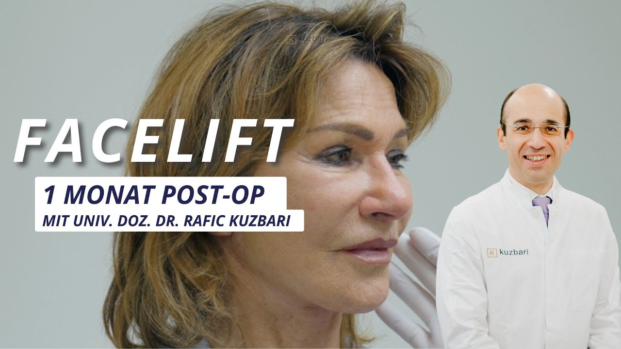 Vorschau: 79 Jahre, Deep Plane Facelift nach 1 Monat