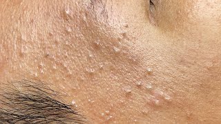 Satisfying Pimple Extraction – One by One 639 P1