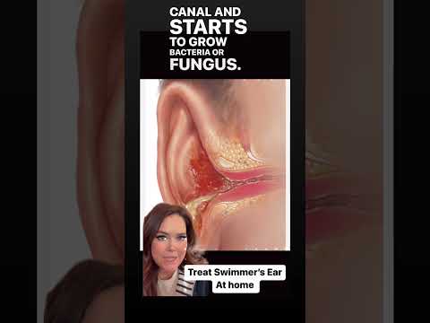 How to treat #swimmersear at home! DIY #homeremedy for Otitis Externa