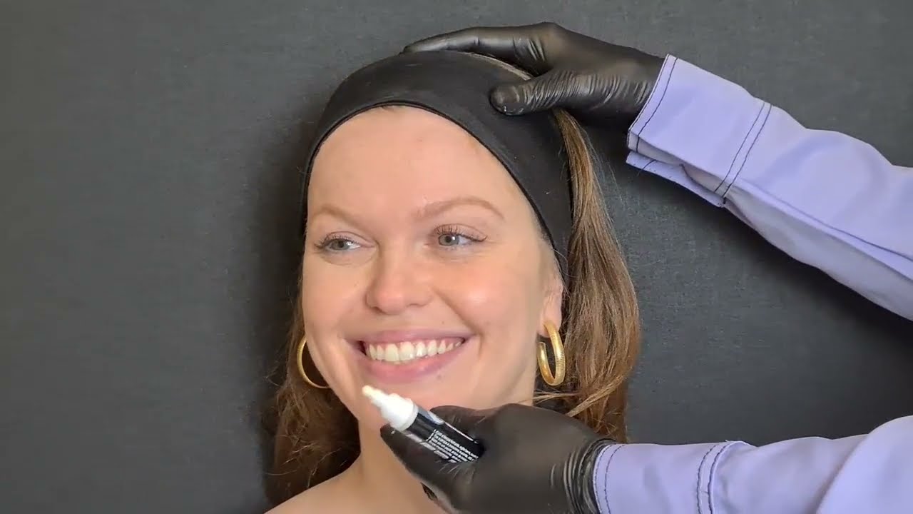 Dra. Carla Scanavini.BOTOX FEMININO MARCAÇÃO