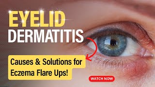 Eyelid Dermatitis Uncovered: Causes and Solutions