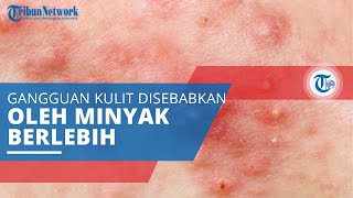Jerawat, Gangguan pada Kulit yang Berhubungan dengan Produksi Minyak (Sebum) yang Berlebihan