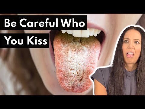 Can You Get A Yeast Infection In Your Mouth?! (White Tongue, Oral Thrush)